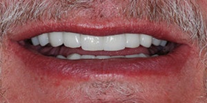 Closeup of smile repaired front tooth