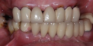 Closeup of teethwithdark coloring and decayaround gums