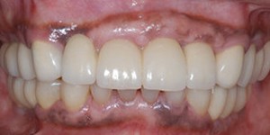 Closeup of healthy complete smile