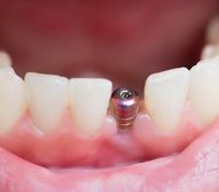 Closeup of dental implant in Allen after placement
