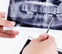 Allen implant dentist pointing to X-ray of missing teeth