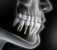 Diagram of dental implants in Allen successfully placed