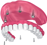 Animation of All-on-4 denture