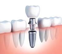 Illustration of single dental implant between natural teeth