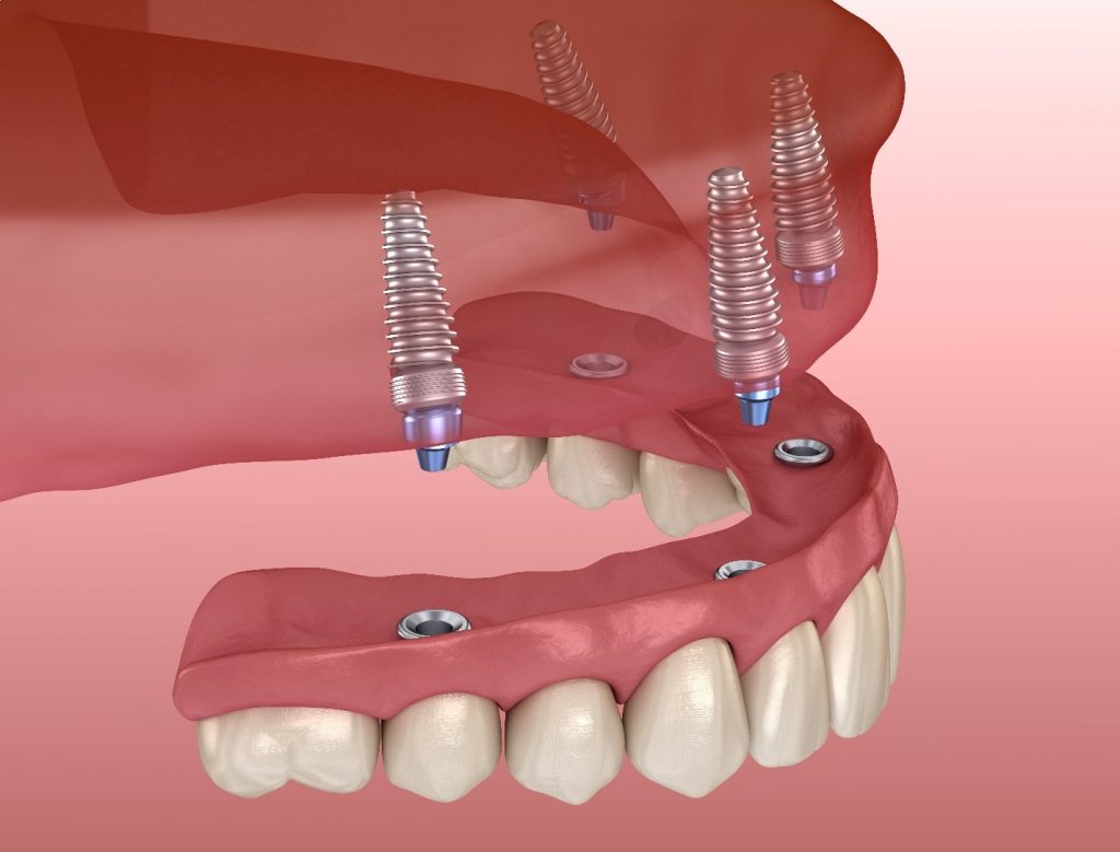 How Many Teeth Can Dental Implants Replace   All On 4 Illustration 1024x779 